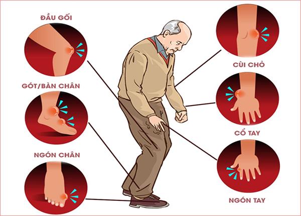 Tìm hiểu triệu chứng và cách điều trị bệnh gút mãn tính