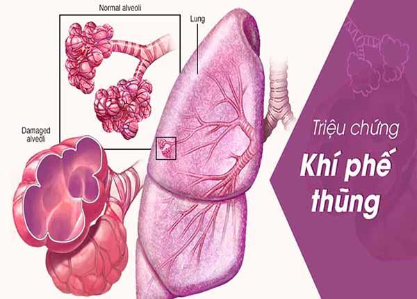 Tìm hiểu về bệnh khí phế thũng từ Bác sĩ Trường Dược Sài Gòn