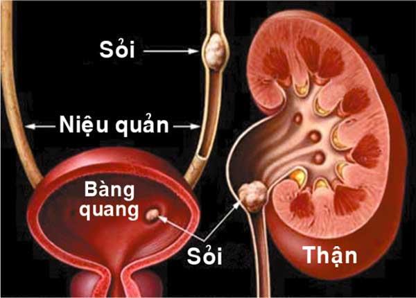 YHCT chia sẻ những món ăn bài thuốc hỗ trợ điều trị bệnh sỏi đường tiết niệu